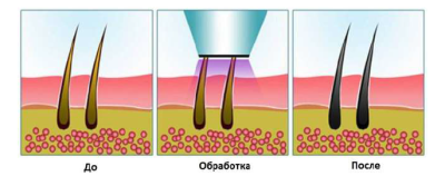 Аппарат для эпиляции GENESIS BEAUTY SYSTEM 1.2